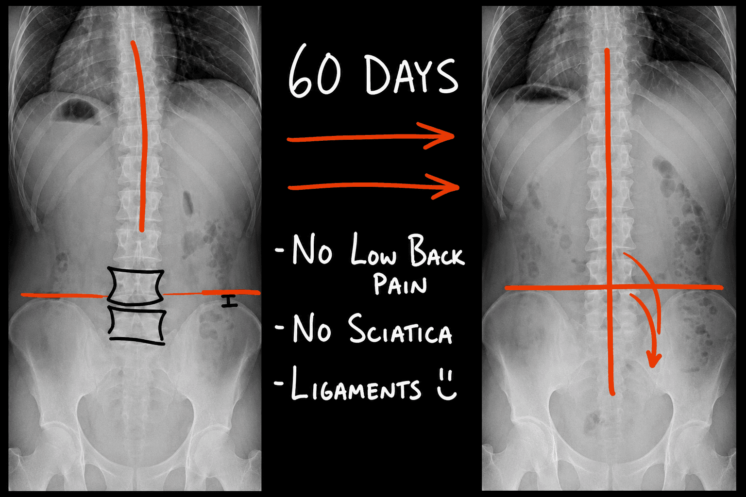Educational comparison of spinal X-rays.