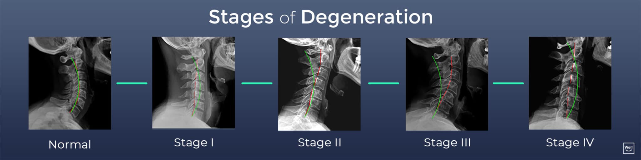 Educational cervical X-rays showing progressive stages of spinal degeneration