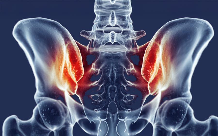 image of hip bones showing red patches at the sacroiliac